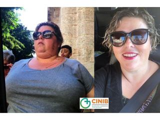 Antes y después Cirugía Obesidad