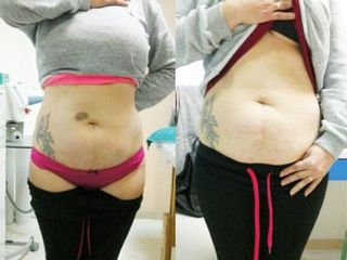 Antes y después  mesoterapia