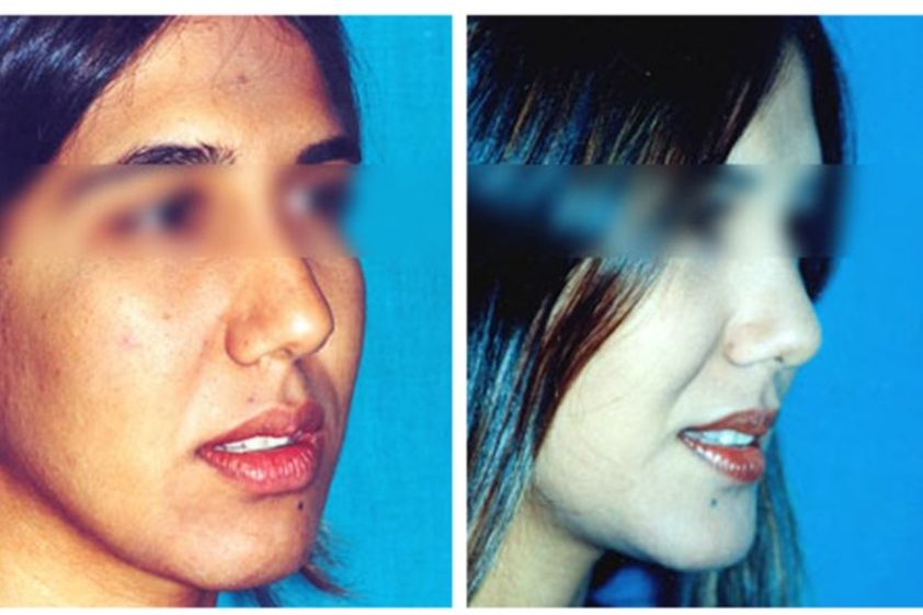 Aumento pómulos antes y después - 493138