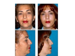 Antes y después Estiramiento facial