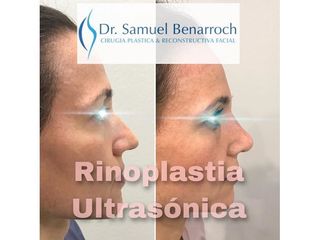 Rinoplastia - Dr. Samuel Benarroch