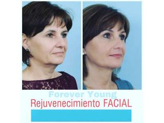 Rejuvenecimiento facial - Dr. Samuel Benarroch
