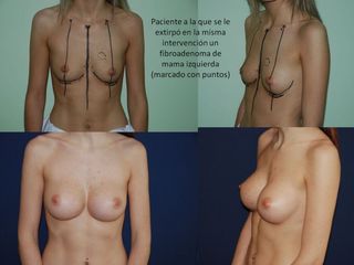 Aumento de pecho - Doctor Terán & Doctora Zavalloni