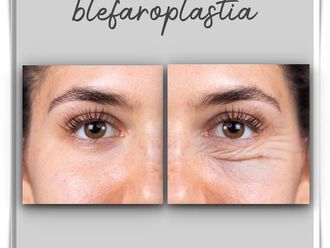 Blefaroplastia - 787388