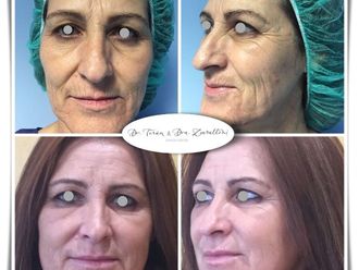 Rejuvenecimiento facial - 787493