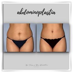 Doctor Terán & Doctora Zavalloni - Abdominoplastia