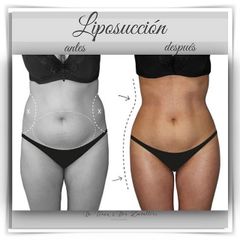 Doctor Terán & Doctora Zavalloni - Liposucción