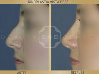 Rinoplastia antes y después