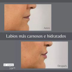 Aumento de labios - Vivanta Logroño