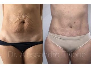 Abdominoplastia - Dr . Alessandro Thione Ph.D.