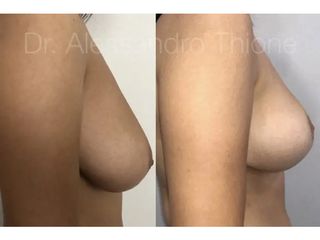 Mastopexia - Dr . Alessandro Thione Ph.D.