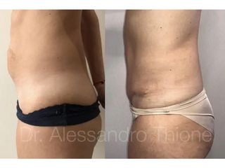 Abdominoplastia - Dr . Alessandro Thione Ph.D.