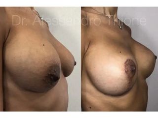 Mastopexia - Dr . Alessandro Thione Ph.D.