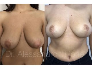 Mastopexia - Dr . Alessandro Thione Ph.D.