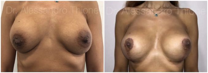 Mastopexia - Dr . Alessandro Thione Ph.D.