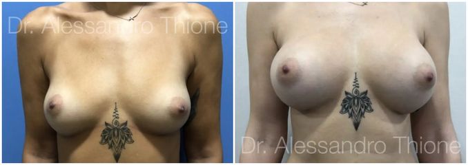 Mastopexia - Dr . Alessandro Thione Ph.D.