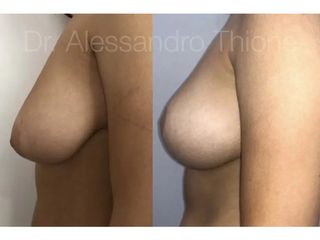 Mastopexia - Dr . Alessandro Thione Ph.D.