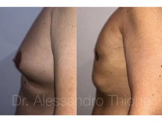Ginecomastia - Dr . Alessandro Thione Ph.D.
