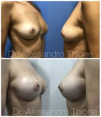 Aumento de pecho - Dr . Alessandro Thione Ph.D.