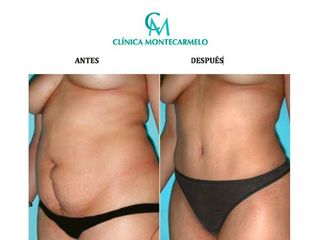 Antes y después Abdominoplastia 