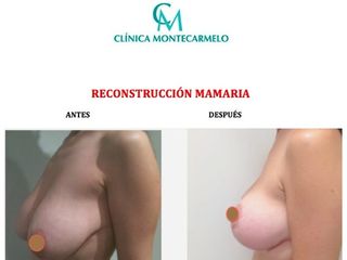 Antes y después Reducción y recostrucción  Mamaria