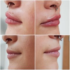 Aumento de labios - Clínica Montecarmelo