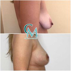Mastopexia - Clínica Montecarmelo