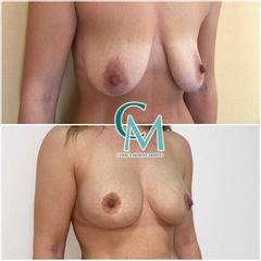 Mastopexia - Clínica Montecarmelo