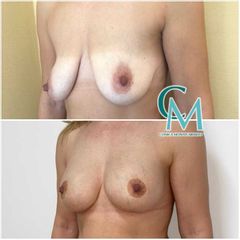Mastopexia - Clínica Montecarmelo