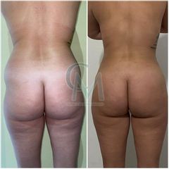Liposuccion - Clínica Montecarmelo