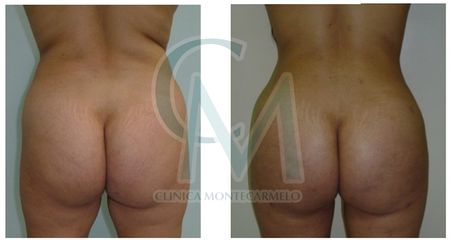 Liposuccion - Clínica Montecarmelo