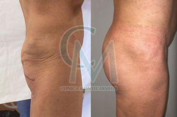 aumento gluteos - Clínica Montecarmelo