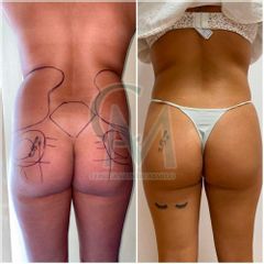 lipoescultura - Clínica Montecarmelo