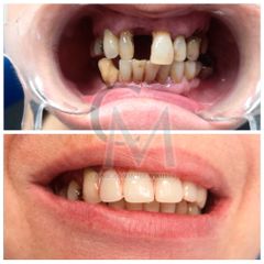 implantes dentales - Clínica Montecarmelo