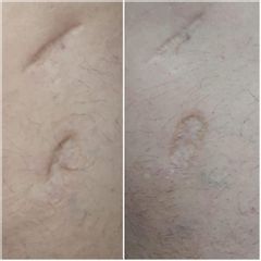 Corrección cicatrices - Clínica Montecarmelo