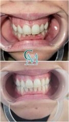 Ortodoncia invisible 3n tres meses - Clínica Montecarmelo