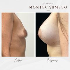 Aumento de pecho - Clinica Montecarmelo