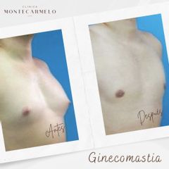 Ginecomastia - Clínica Montecarmelo