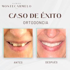 Ortodoncia - Clínica Montecarmelo