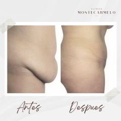 Abdominoplastia - Clínica Montecarmelo