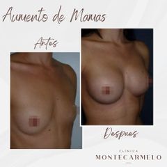 Aumento de pecho - Clínica Montecarmelo