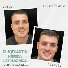 Rinoplastia - Clínica Montecarmelo