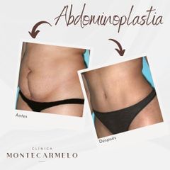 Abdominoplastia - Clínica Montecarmelo