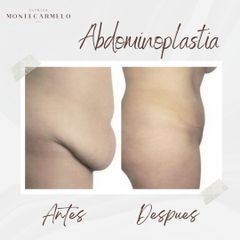 Abdominoplastia - Clínica Montecarmelo