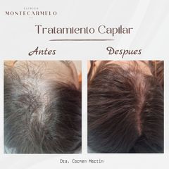 Tratamiento capilar - Clínica Montecarmelo