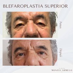 Blefaroplastia - Clínica Montecarmelo