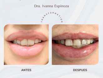 Queiloplastia antes y después - 867316