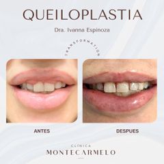 Queiloplastia - Clínica Montecarmelo