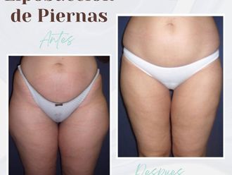 Liposucción antes y después - 867319