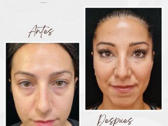 Eliminación ojeras antes y después - 867320